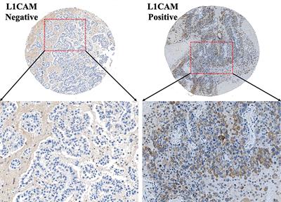 L1CAM expression in either metastatic brain lesion or peripheral blood is correlated with peripheral platelet count in patients with brain metastases from lung cancer